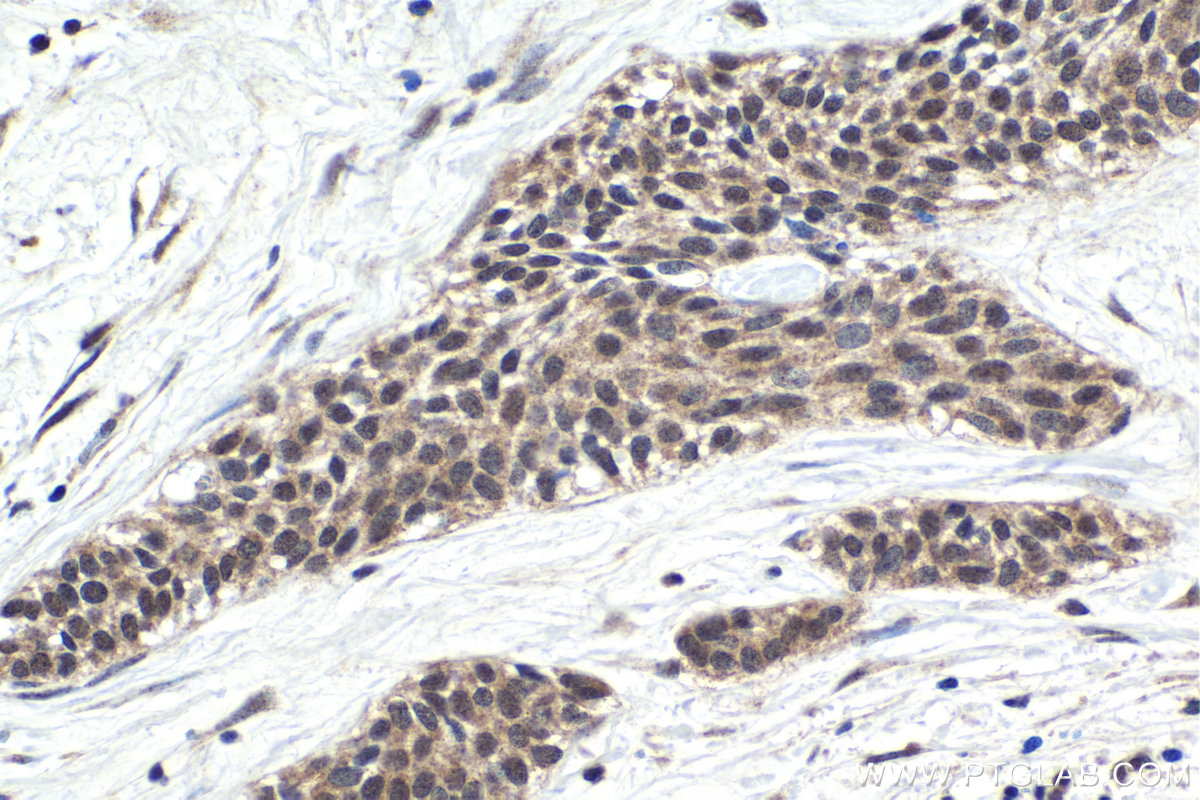 Immunohistochemistry (IHC) staining of human urothelial carcinoma tissue using ZC3H12A Polyclonal antibody (25009-1-AP)