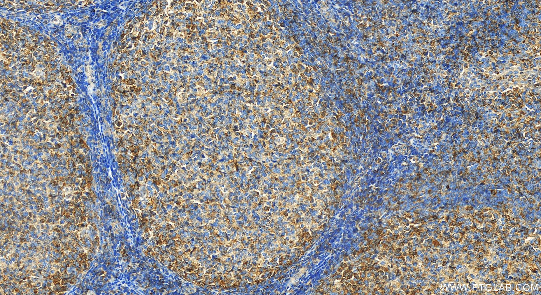 Immunohistochemistry (IHC) staining of human tonsillitis tissue using ZC3H12D Polyclonal antibody (24991-1-AP)