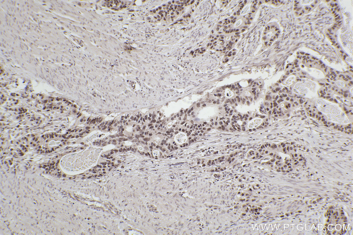 Immunohistochemistry (IHC) staining of human stomach cancer tissue using ZC3H13 Monoclonal antibody (68526-1-Ig)