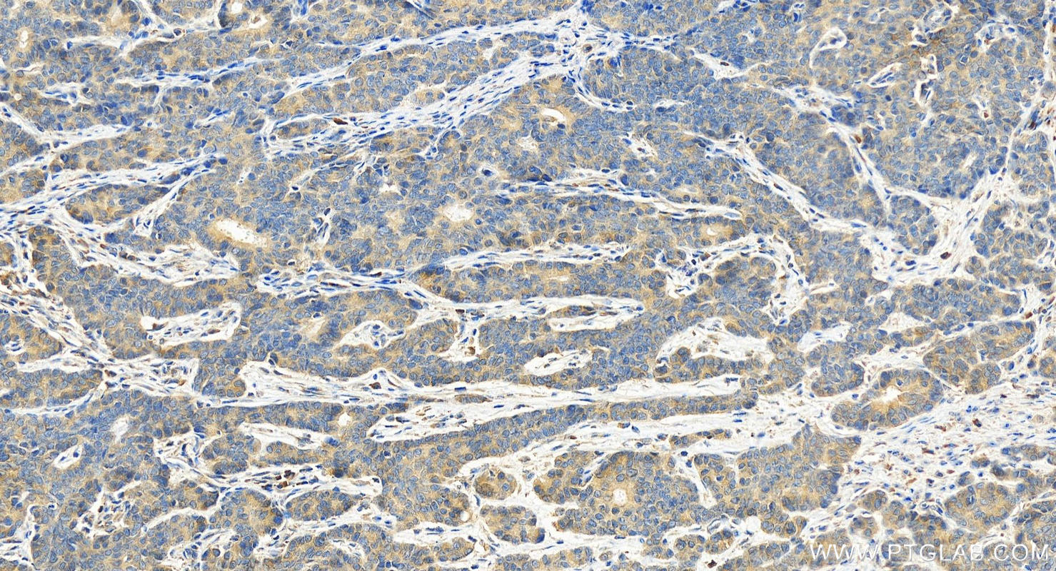 Immunohistochemistry (IHC) staining of human stomach cancer tissue using ZC3HAV1 Polyclonal antibody (16820-1-AP)