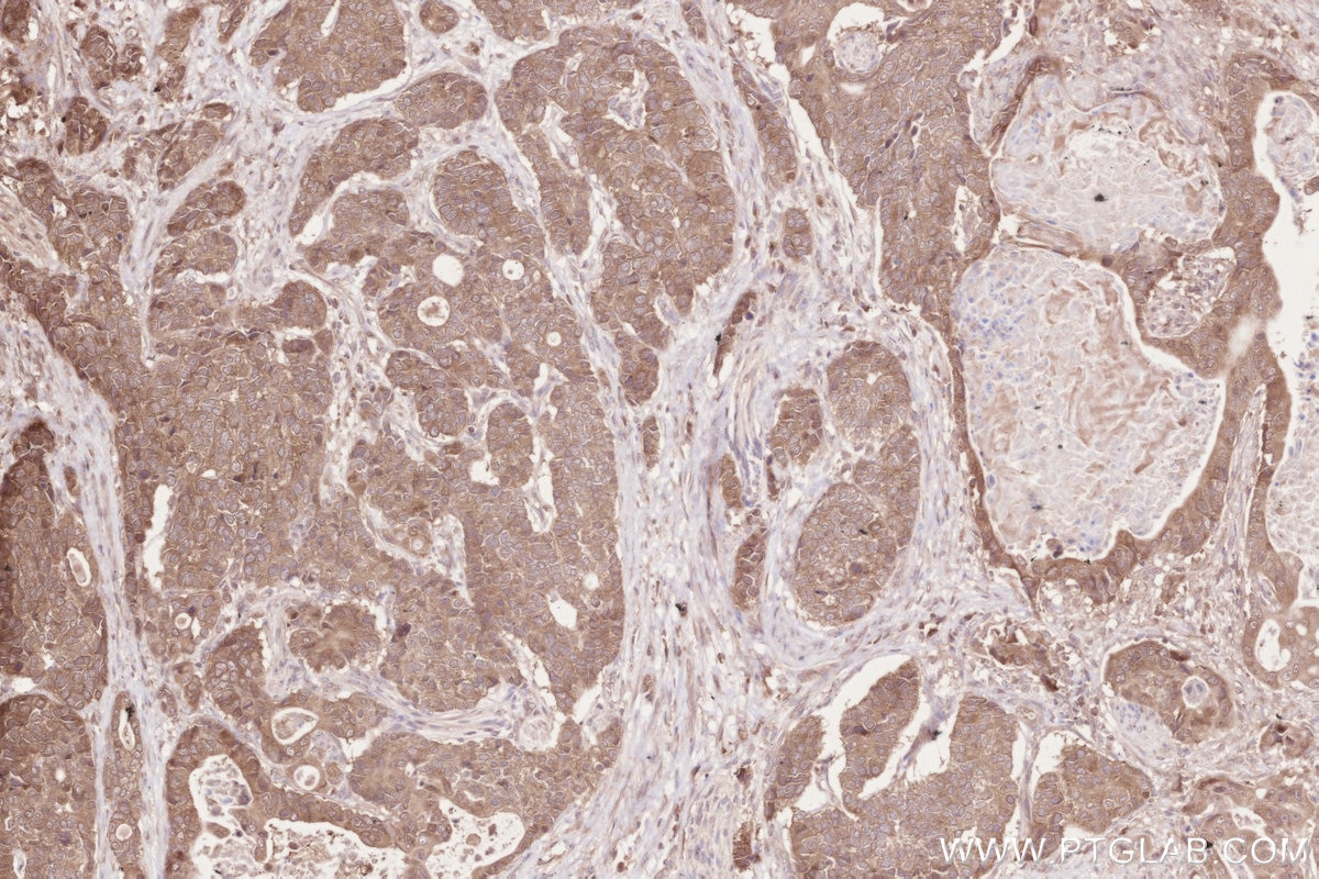 Immunohistochemistry (IHC) staining of human stomach cancer tissue using ZC3HAV1 Polyclonal antibody (16820-1-AP)