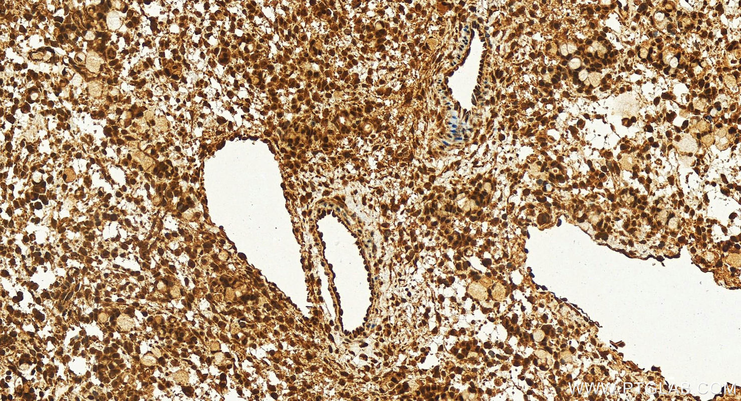 Immunohistochemistry (IHC) staining of human ovary cancer tissue using ZCRB1 Polyclonal antibody (25629-1-AP)