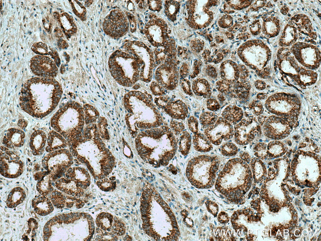 Immunohistochemistry (IHC) staining of human prostate cancer tissue using ZFHX3 Polyclonal antibody (20157-1-AP)