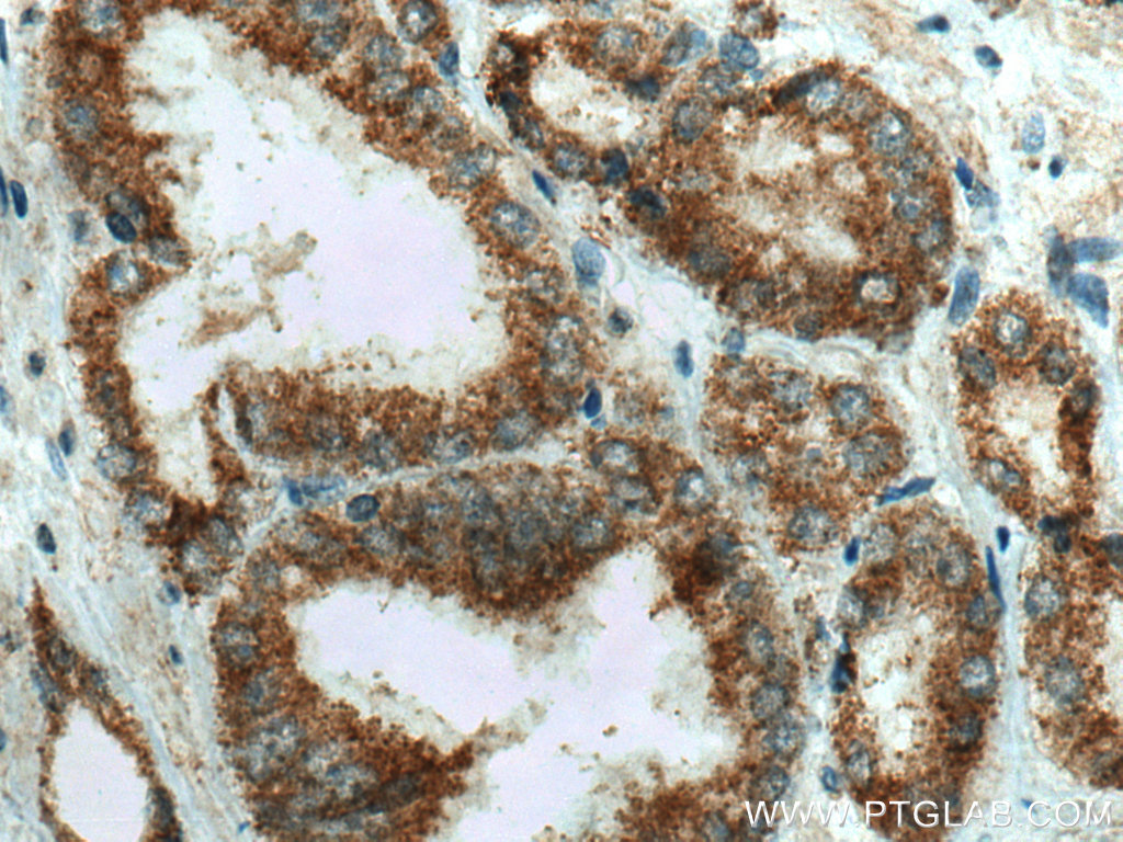 Immunohistochemistry (IHC) staining of human prostate cancer tissue using ZFHX3 Polyclonal antibody (20157-1-AP)