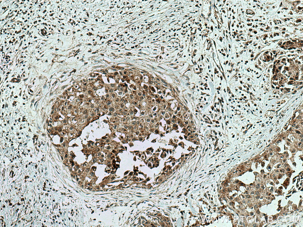 Immunohistochemistry (IHC) staining of human breast cancer tissue using ZFHX3 Polyclonal antibody (20157-1-AP)