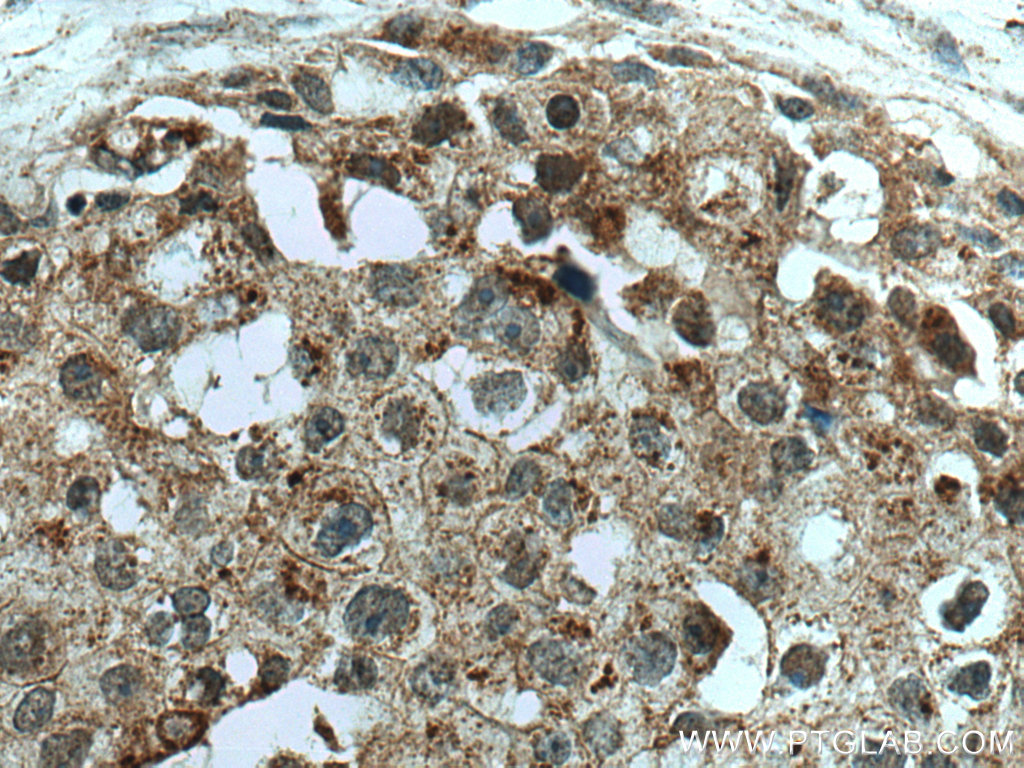 Immunohistochemistry (IHC) staining of human breast cancer tissue using ZFHX3 Polyclonal antibody (20157-1-AP)