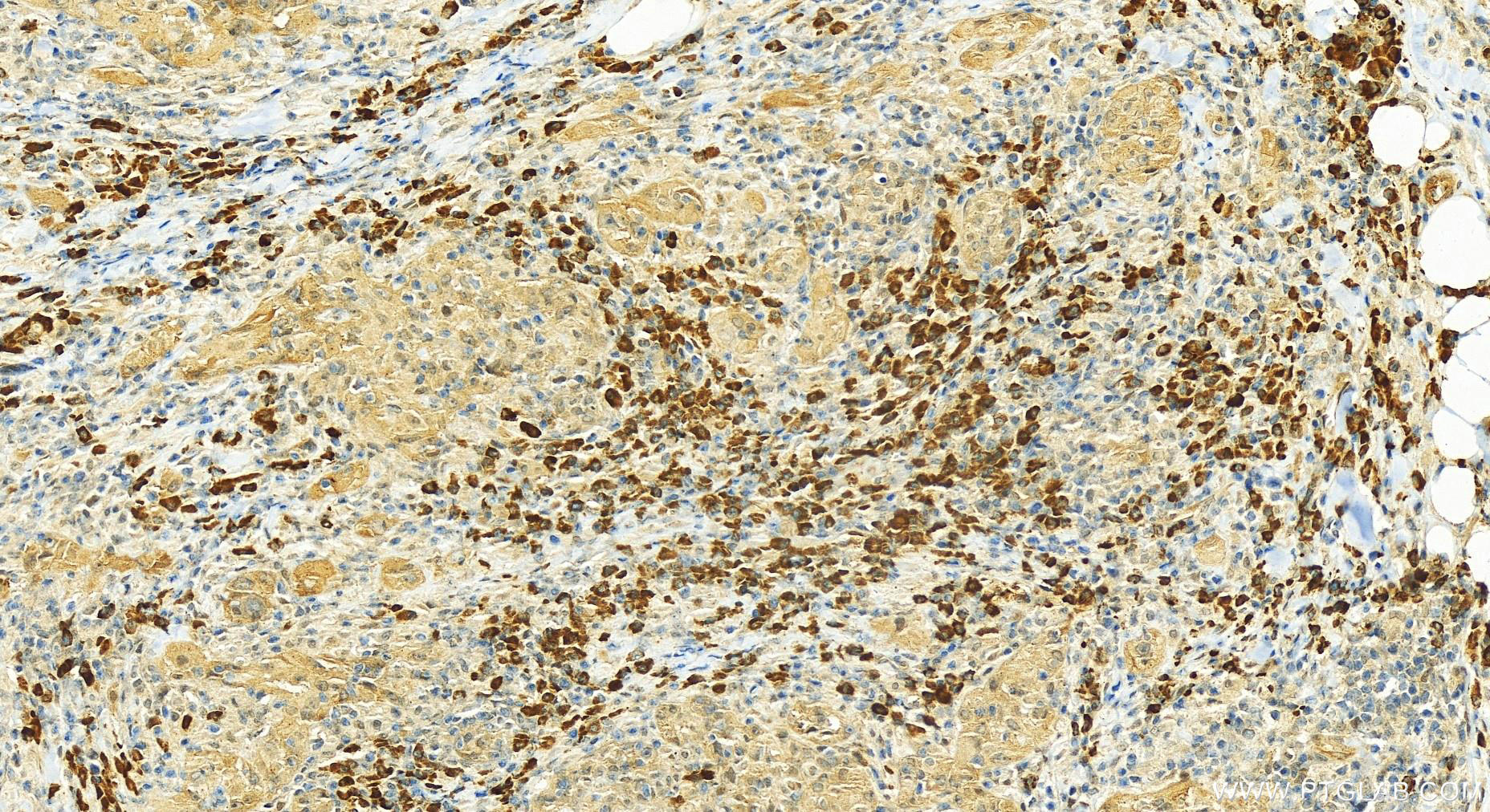 Immunohistochemistry (IHC) staining of human skin cancer tissue using ZFP36L2 Polyclonal antibody (19005-1-AP)