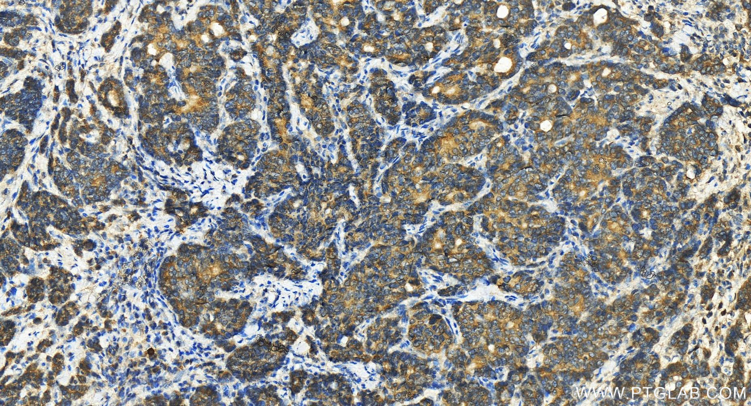 Immunohistochemistry (IHC) staining of human stomach cancer tissue using Protrudin Polyclonal antibody (12680-1-AP)