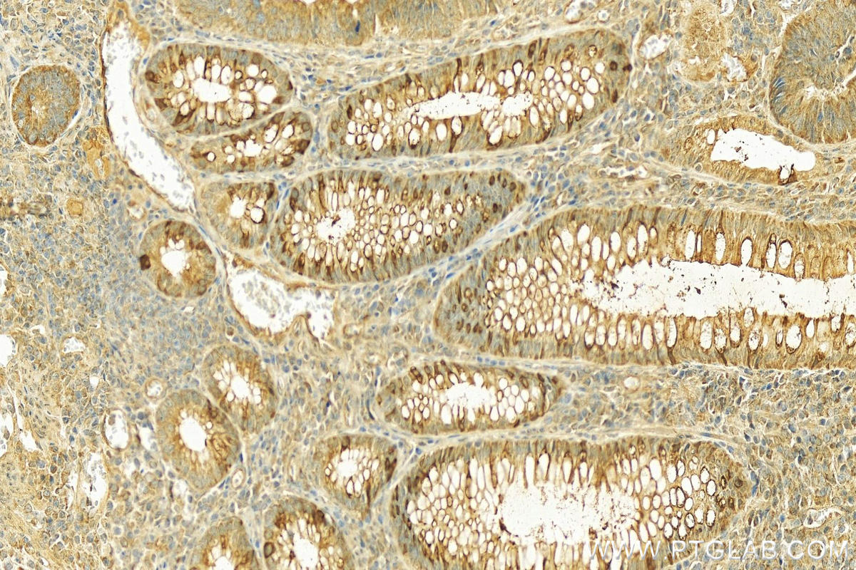 Immunohistochemistry (IHC) staining of human colon cancer tissue using ZG16 Polyclonal antibody (17397-1-AP)