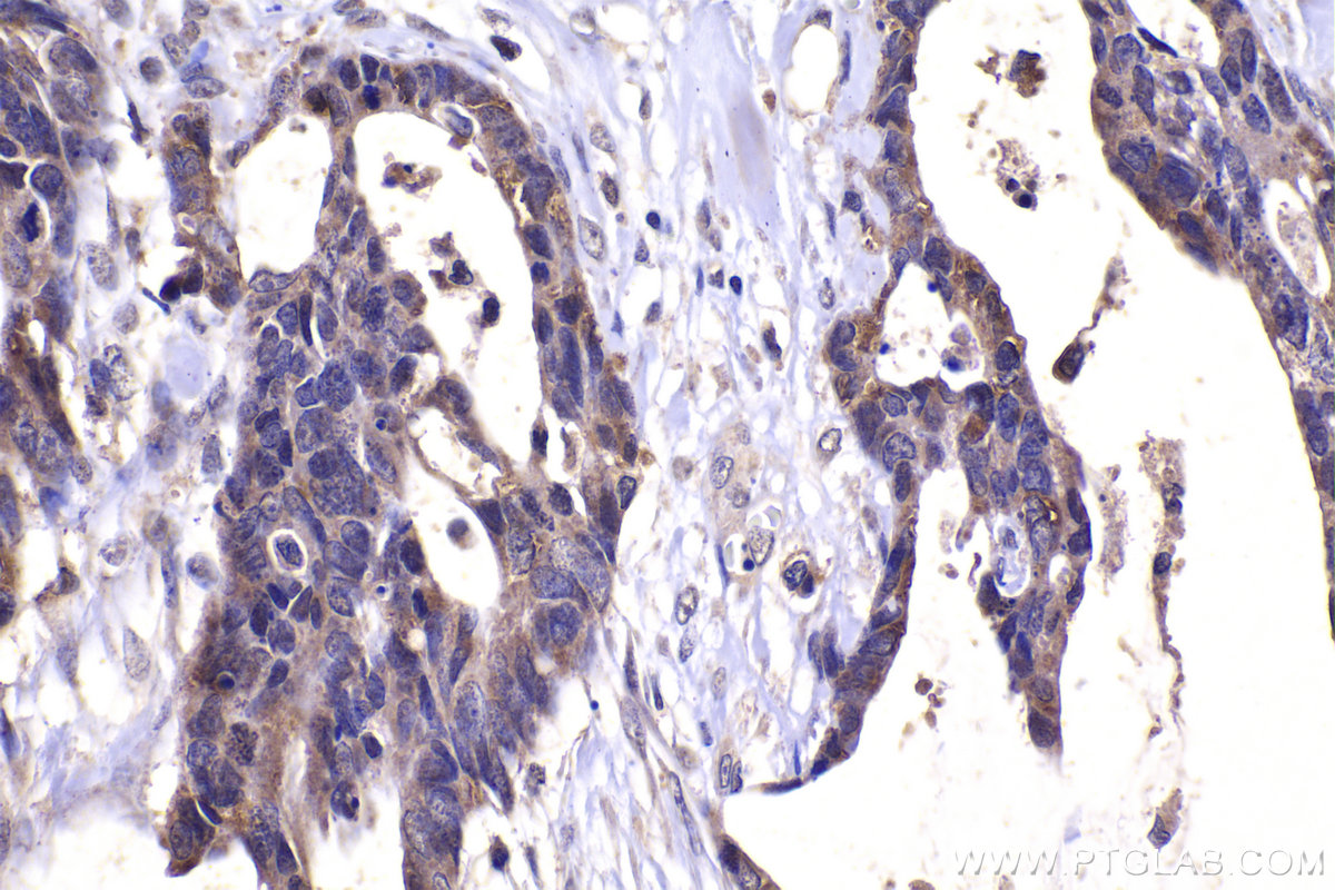 Immunohistochemistry (IHC) staining of human urothelial carcinoma tissue using ZIC3 Polyclonal antibody (21717-1-AP)