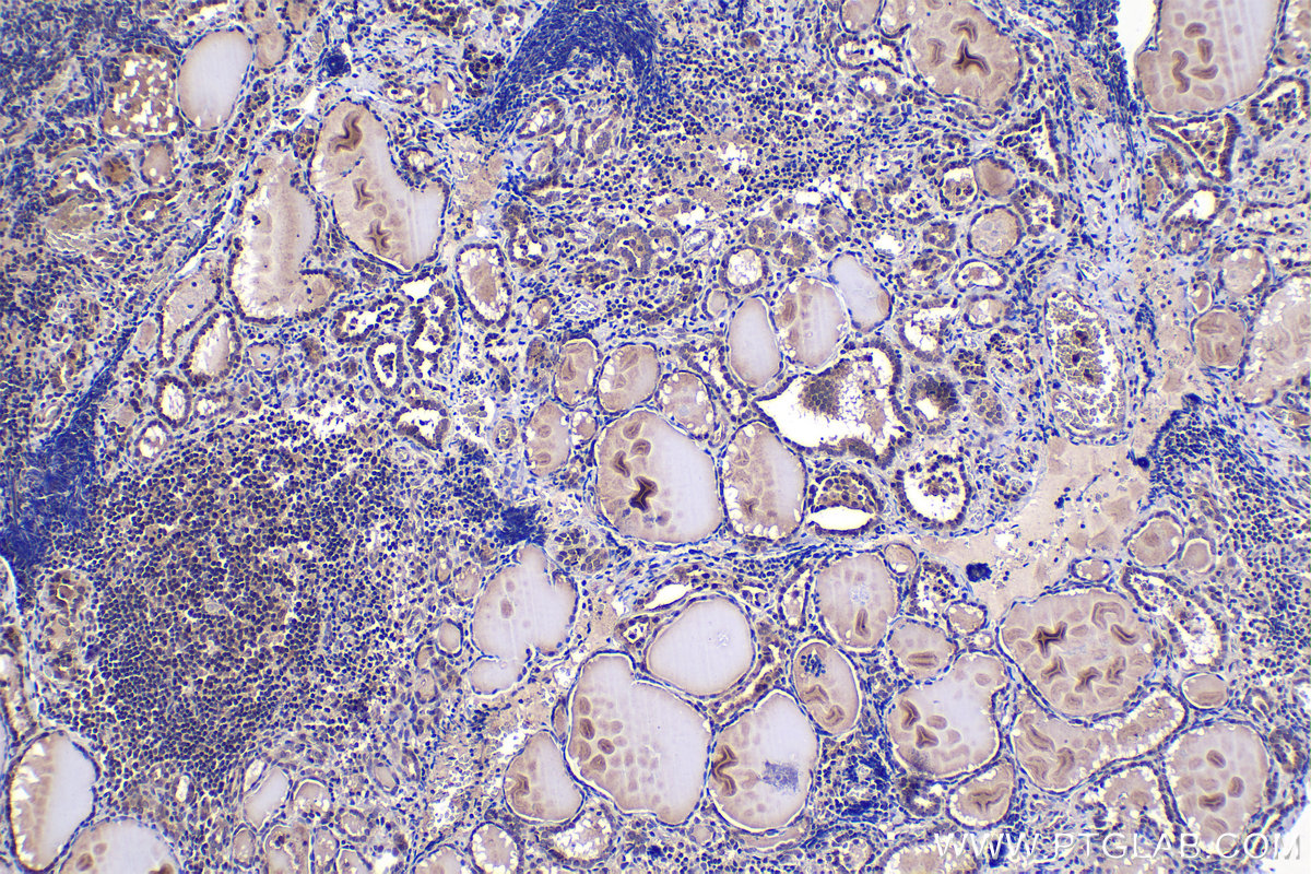 Immunohistochemistry (IHC) staining of human thyroid cancer tissue using ZIC3 Polyclonal antibody (21717-1-AP)