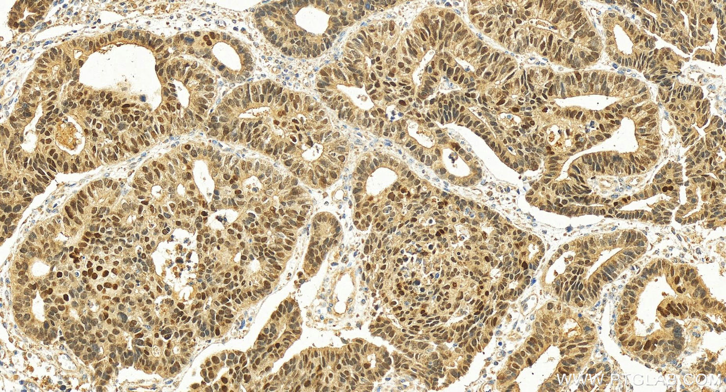 Immunohistochemistry (IHC) staining of human stomach cancer tissue using ZNF101 Polyclonal antibody (25599-1-AP)