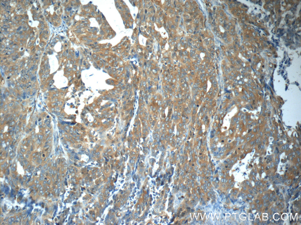 Immunohistochemistry (IHC) staining of human ovary tumor tissue using ZNF259 Polyclonal antibody (15558-1-AP)