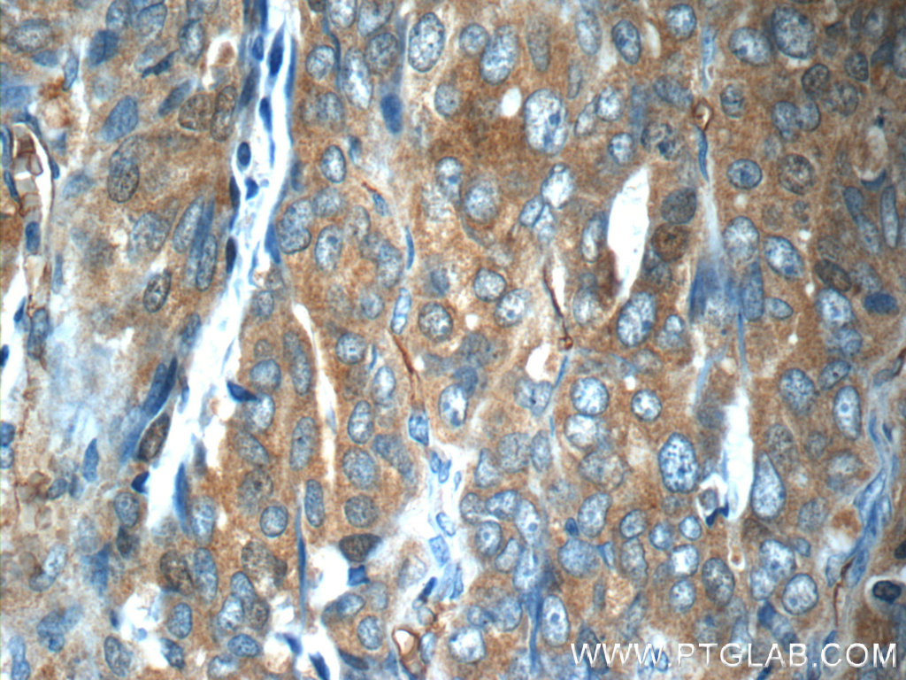 Immunohistochemistry (IHC) staining of human ovary tumor tissue using ZNF259 Polyclonal antibody (15558-1-AP)