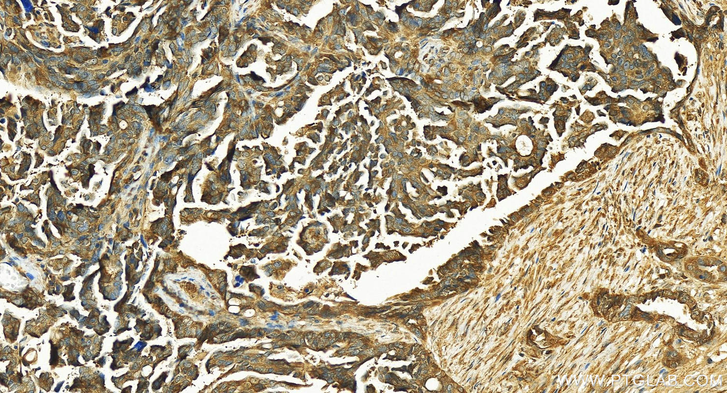 Immunohistochemistry (IHC) staining of human ovary cancer tissue using ZNF259 Polyclonal antibody (15558-1-AP)