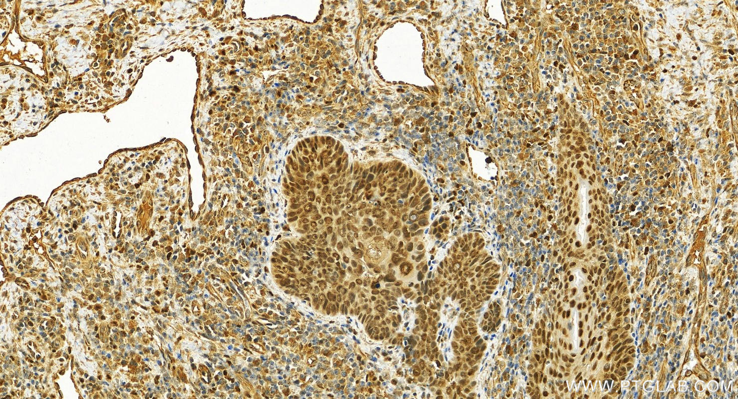 Immunohistochemistry (IHC) staining of human brown disease using ZNF385A Polyclonal antibody (26288-1-AP)