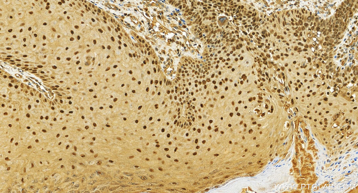 Immunohistochemistry (IHC) staining of human brown disease using ZNF385A Polyclonal antibody (26288-1-AP)