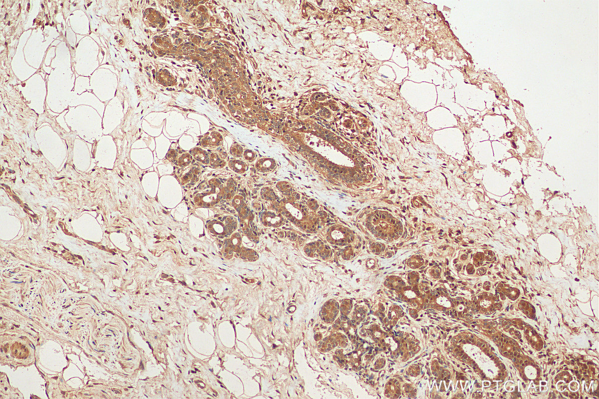 Immunohistochemistry (IHC) staining of human breast cancer tissue using ZNF703 Polyclonal antibody (21075-1-AP)