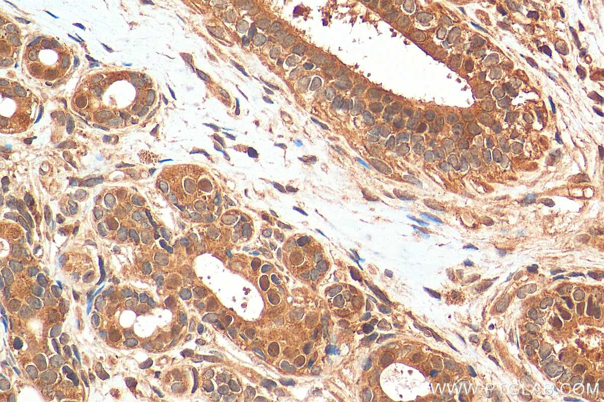 Immunohistochemistry (IHC) staining of human breast cancer tissue using ZNF703 Polyclonal antibody (21075-1-AP)