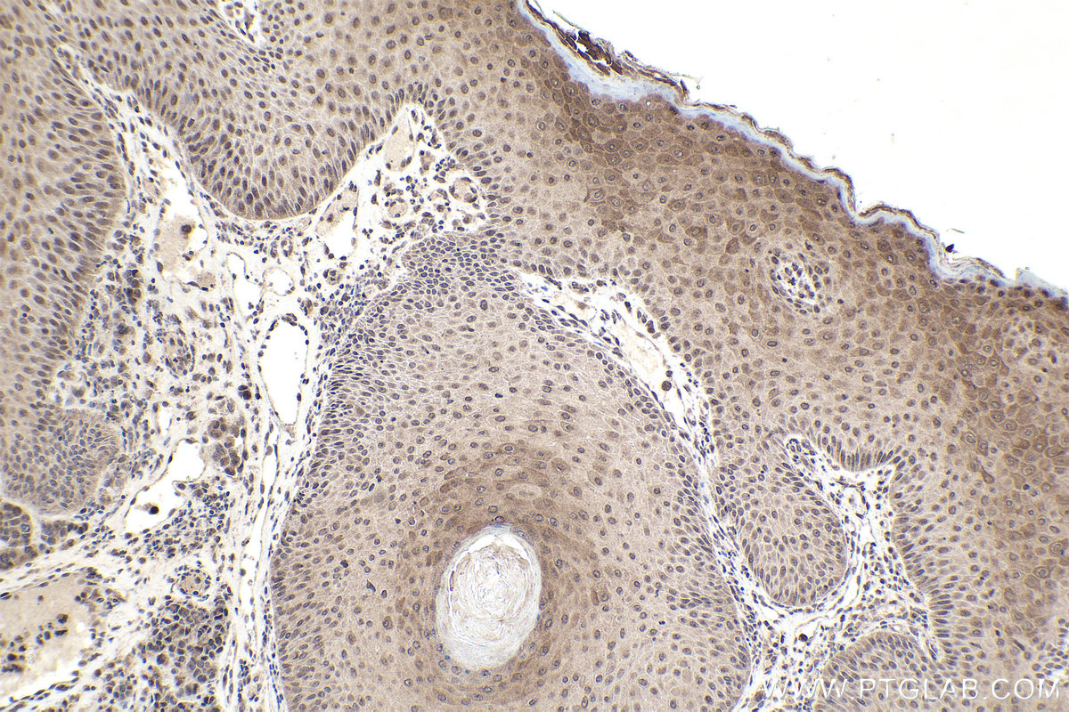 Immunohistochemistry (IHC) staining of human malignant melanoma tissue using ZNF703 Polyclonal antibody (21075-1-AP)