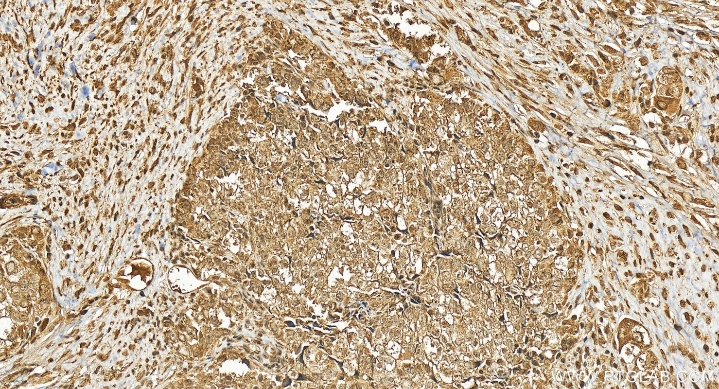 Immunohistochemistry (IHC) staining of human ovary cancer tissue using ZNF740 Polyclonal antibody (25411-1-AP)