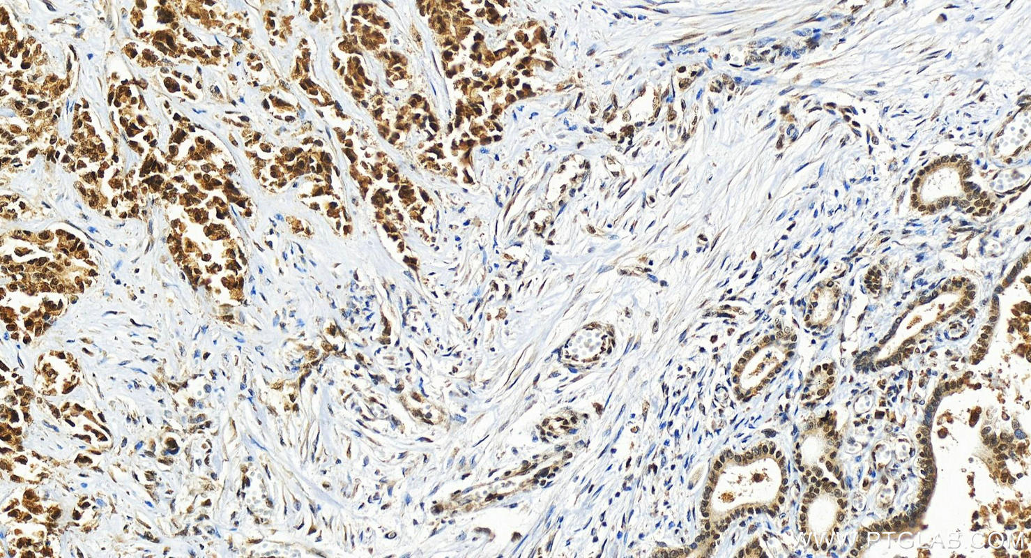 Immunohistochemistry (IHC) staining of human intrahepatic cholangiocarcinoma tissue using ZNF828 Polyclonal antibody (26315-1-AP)