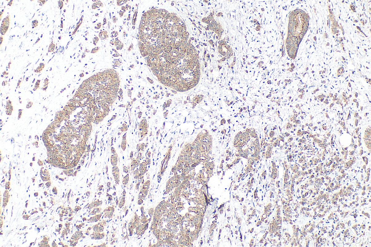 Immunohistochemistry (IHC) staining of human breast cancer tissue using ZO-1 Polyclonal antibody (21773-1-AP)
