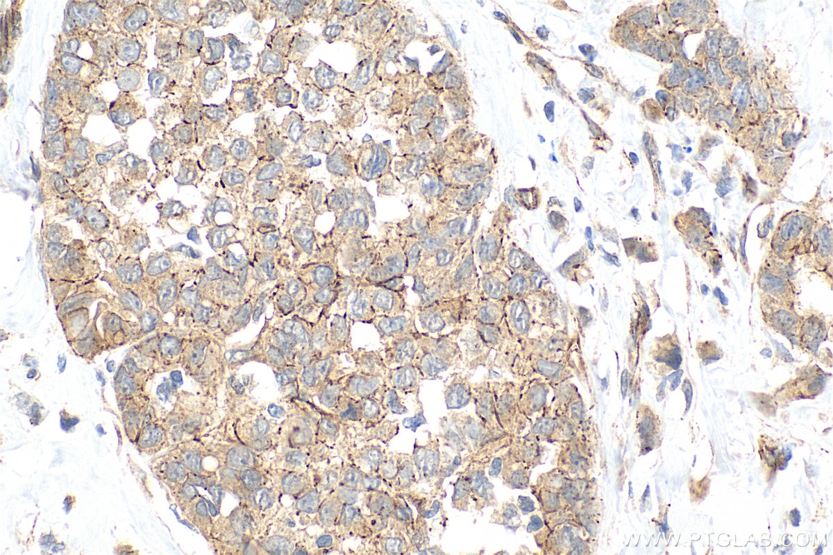 Immunohistochemistry (IHC) staining of human breast cancer tissue using ZO-1 Polyclonal antibody (21773-1-AP)