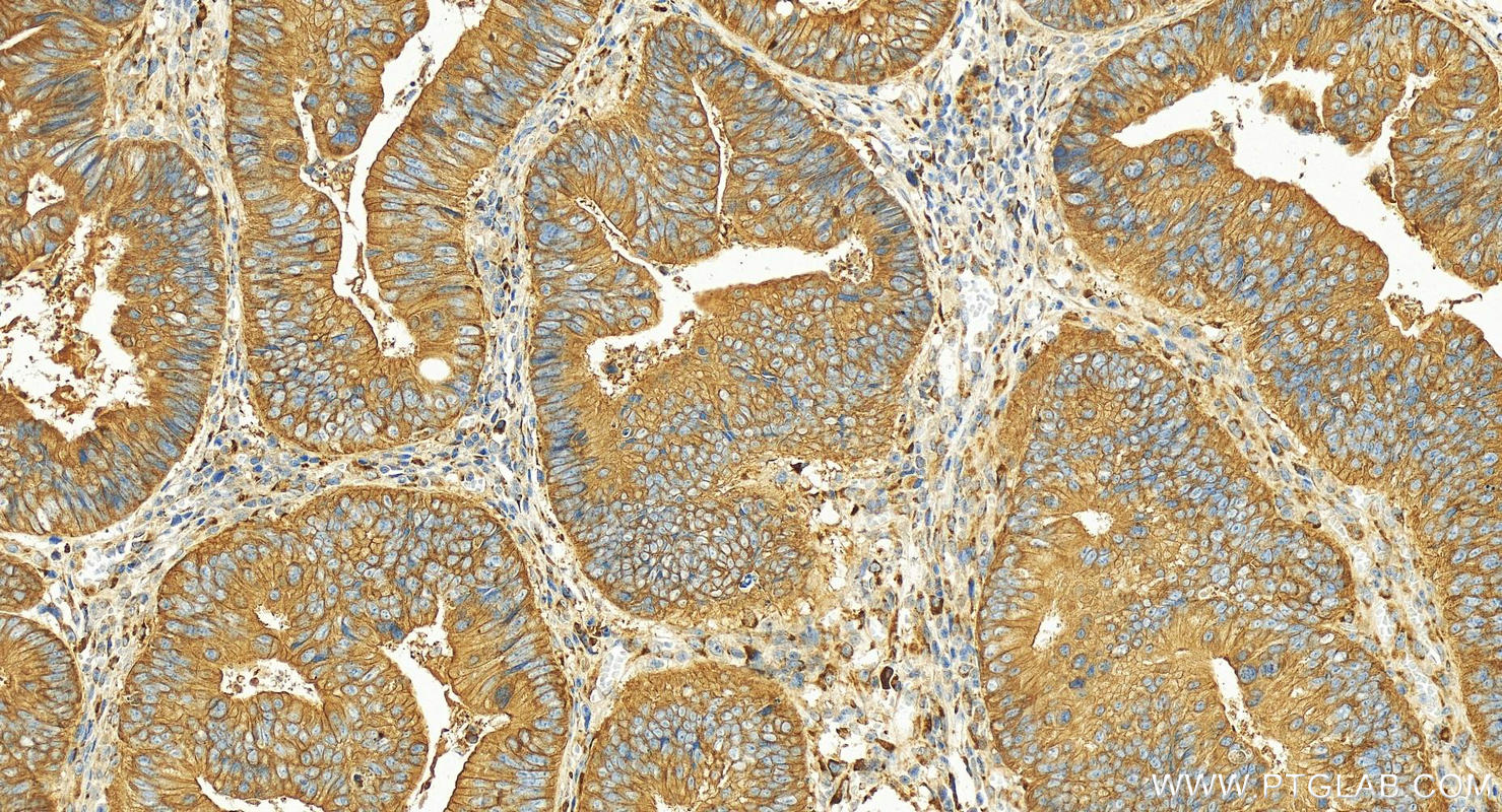 Immunohistochemistry (IHC) staining of human colon cancer tissue using ZWILCH Polyclonal antibody (14281-1-AP)