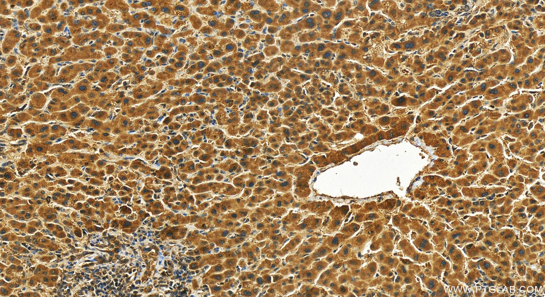 Immunohistochemistry (IHC) staining of human intrahepatic cholangiocarcinoma tissue using Znt5 Polyclonal antibody (25604-1-AP)