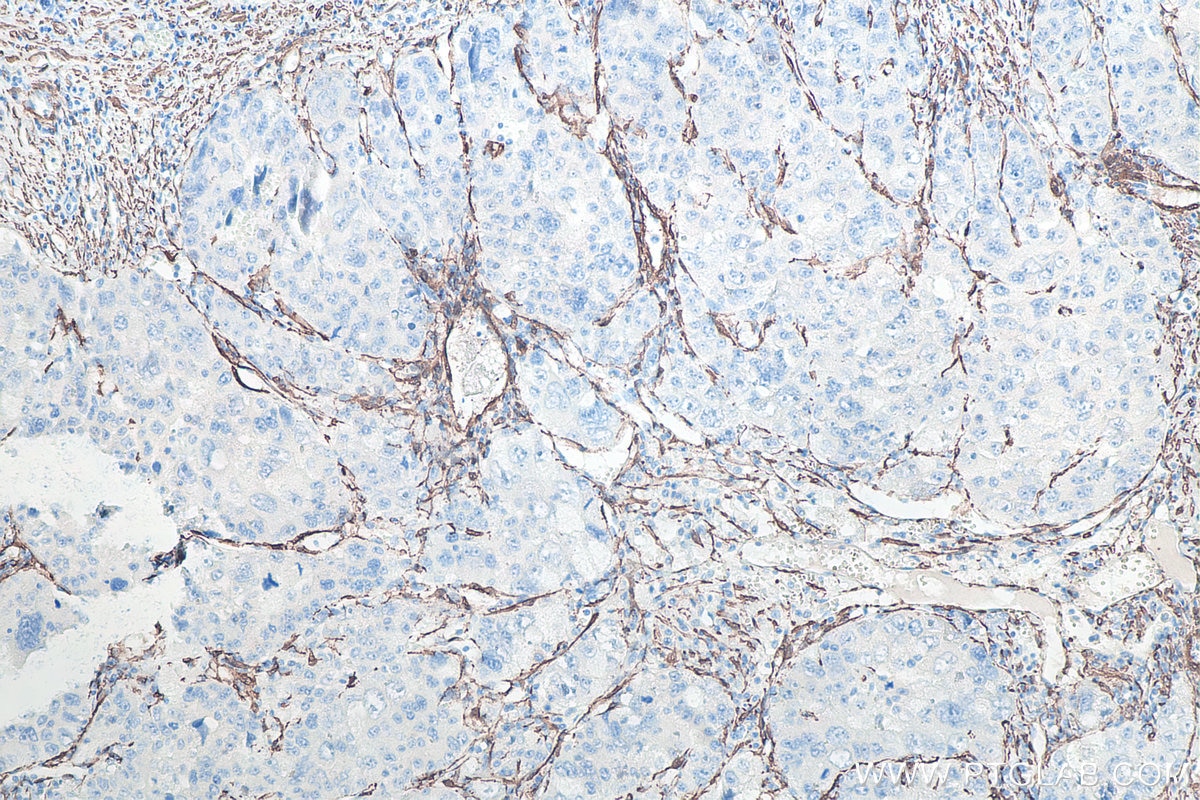 Immunohistochemistry (IHC) staining of human liver cancer tissue using Alpha smooth muscle actin specific Recombinant mon (80008-1-RR)