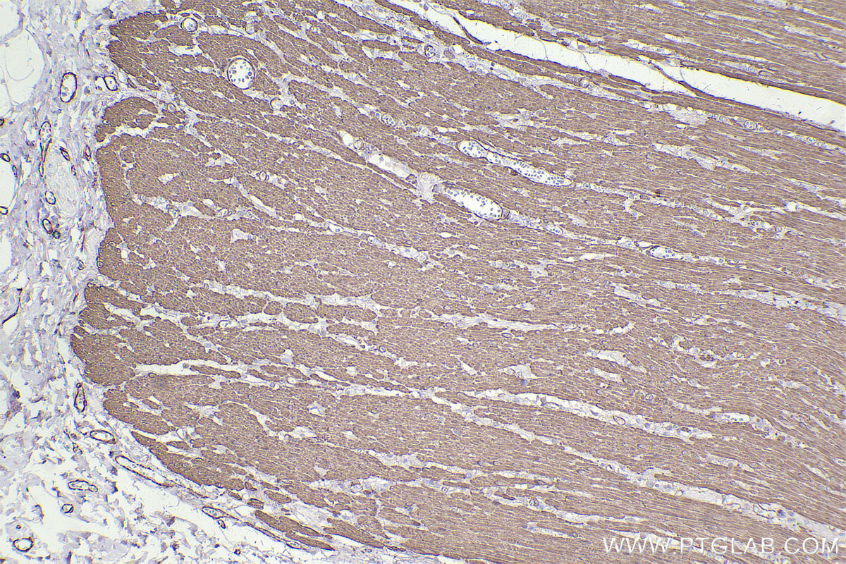 Immunohistochemistry (IHC) staining of human rectal cancer tissue using Alpha smooth muscle actin specific Recombinant ant (80008-1-RR)