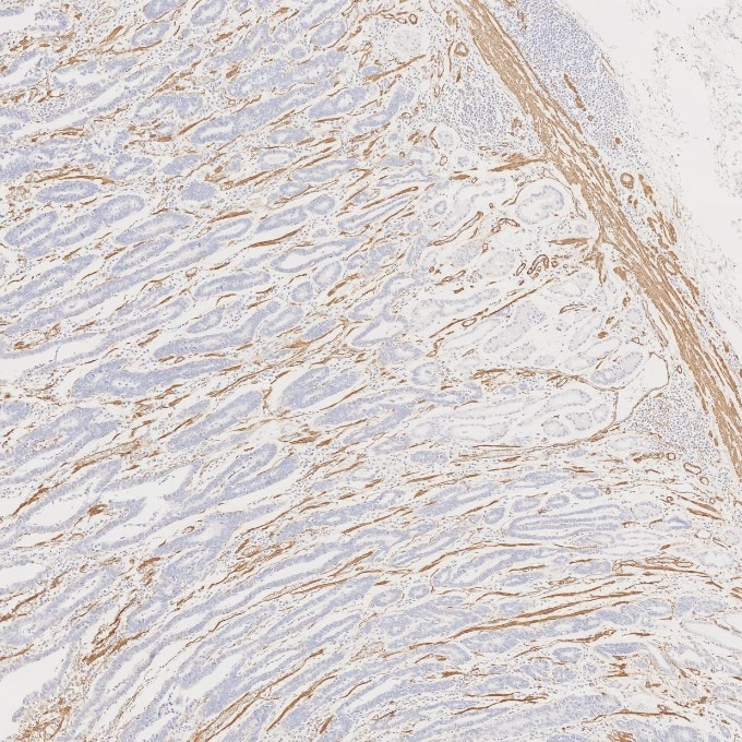 Immunohistochemistry (IHC) staining of human stomach cancer tissue using Alpha smooth muscle actin specific Recombinant mon (80008-1-RR)