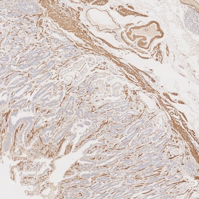 Immunohistochemistry (IHC) staining of human stomach cancer tissue using Alpha smooth muscle actin specific Recombinant mon (80008-1-RR)