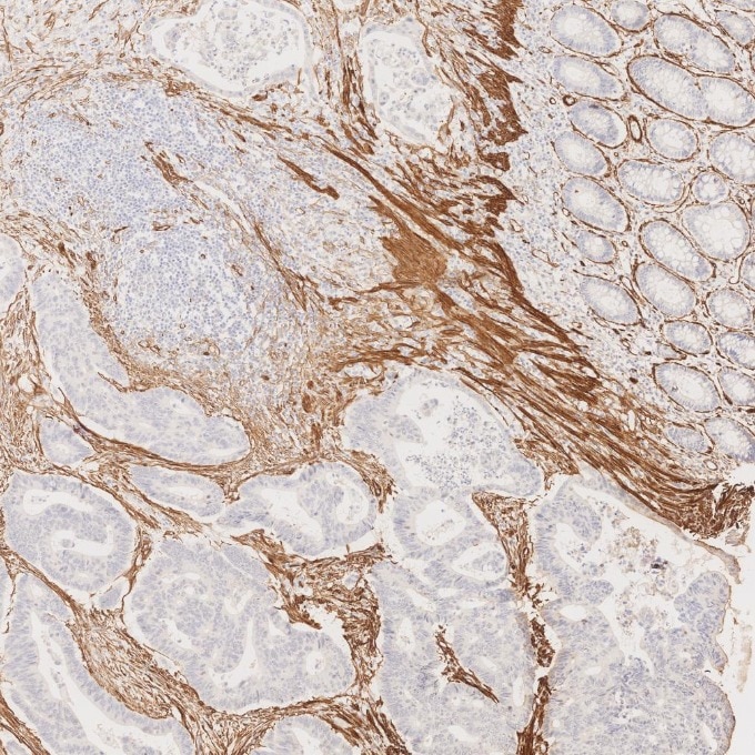 Immunohistochemistry (IHC) staining of human colorectal cancer tissue using Alpha smooth muscle actin specific Recombinant mon (80008-1-RR)
