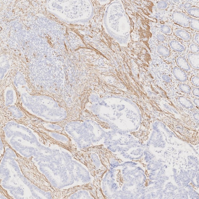 Immunohistochemistry (IHC) staining of human colorectal cancer tissue using Alpha smooth muscle actin specific Recombinant mon (80008-1-RR)