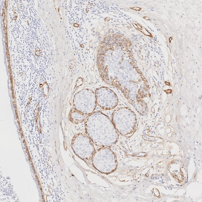 Immunohistochemistry (IHC) staining of human breast cancer tissue using Alpha smooth muscle actin specific Recombinant mon (80008-1-RR)