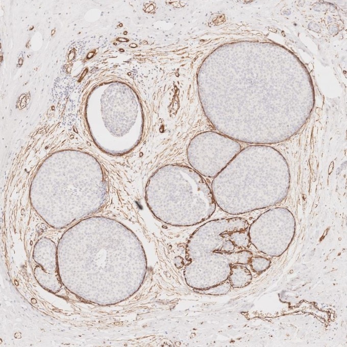 Immunohistochemistry (IHC) staining of human breast cancer tissue using Alpha smooth muscle actin specific Recombinant mon (80008-1-RR)