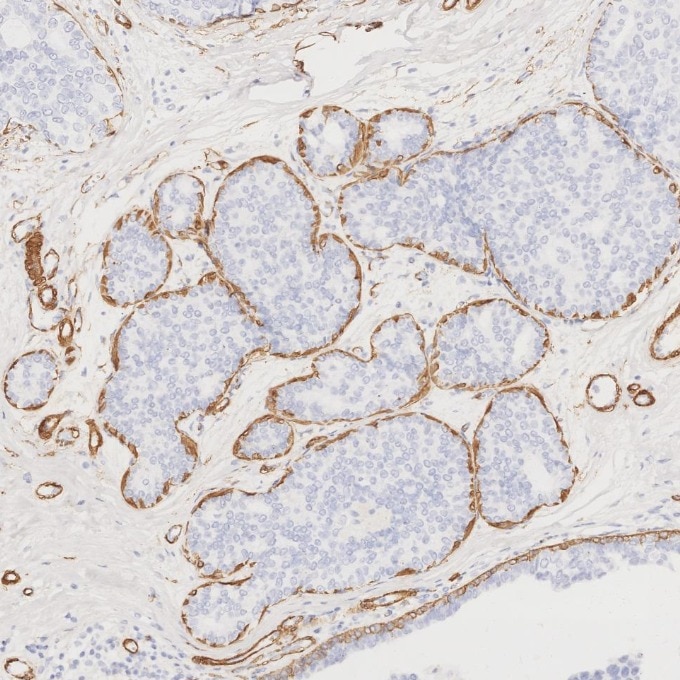Immunohistochemistry (IHC) staining of human breast cancer tissue using Alpha smooth muscle actin specific Recombinant mon (80008-1-RR)
