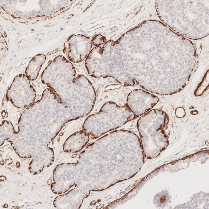 Immunohistochemistry (IHC) staining of human breast cancer tissue using Alpha smooth muscle actin specific Recombinant mon (80008-1-RR)