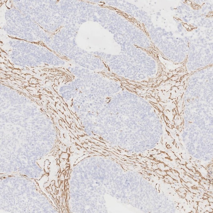Immunohistochemistry (IHC) staining of human ovary cancer tissue using Alpha smooth muscle actin specific Recombinant mon (80008-1-RR)