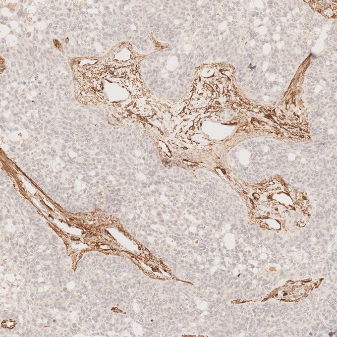 Immunohistochemistry (IHC) staining of human ovary cancer tissue using Alpha smooth muscle actin specific Recombinant mon (80008-1-RR)