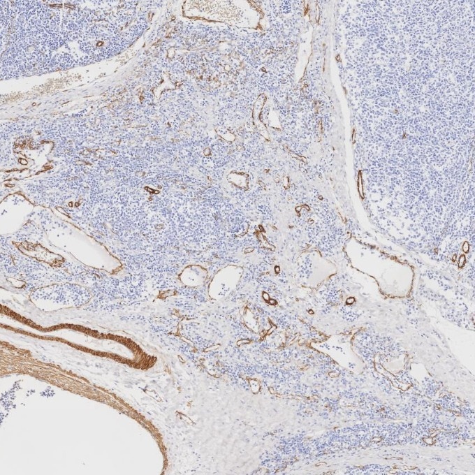 Immunohistochemistry (IHC) staining of human tonsillitis tissue using Alpha smooth muscle actin specific Recombinant mon (80008-1-RR)