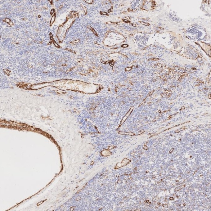 Immunohistochemistry (IHC) staining of human tonsillitis tissue using Alpha smooth muscle actin specific Recombinant mon (80008-1-RR)