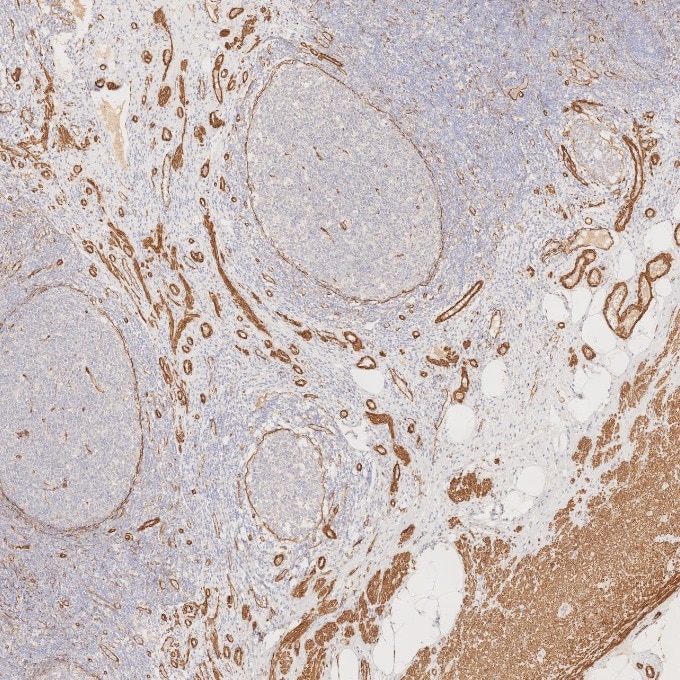 Immunohistochemistry (IHC) staining of human appendicitis tissue using Alpha smooth muscle actin specific Recombinant mon (80008-1-RR)