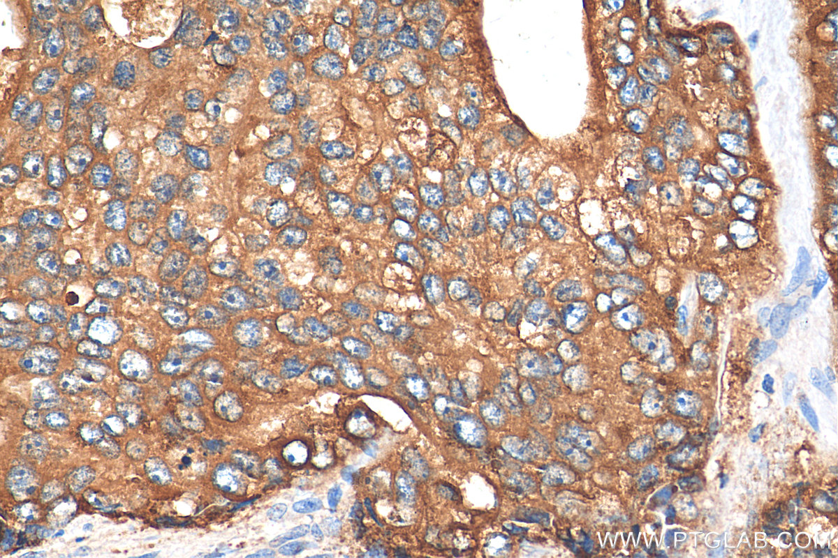 Immunohistochemistry (IHC) staining of human prostate hyperplasia tissue using ACPP Polyclonal antibody (24410-1-AP)