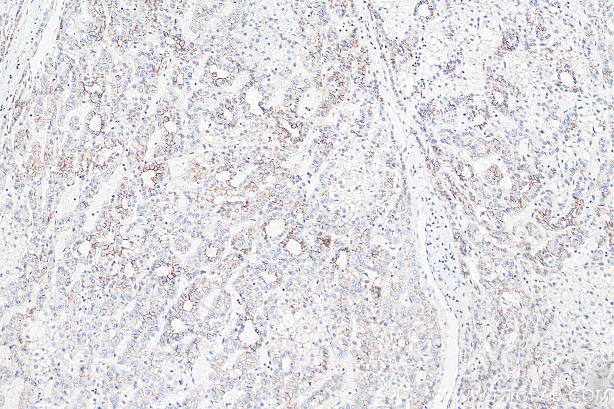 Immunohistochemistry (IHC) staining of human liver cancer tissue using Beta Catenin Polyclonal antibody (51067-2-AP)