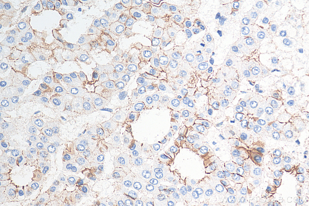 Immunohistochemistry (IHC) staining of human liver cancer tissue using Beta Catenin Polyclonal antibody (51067-2-AP)