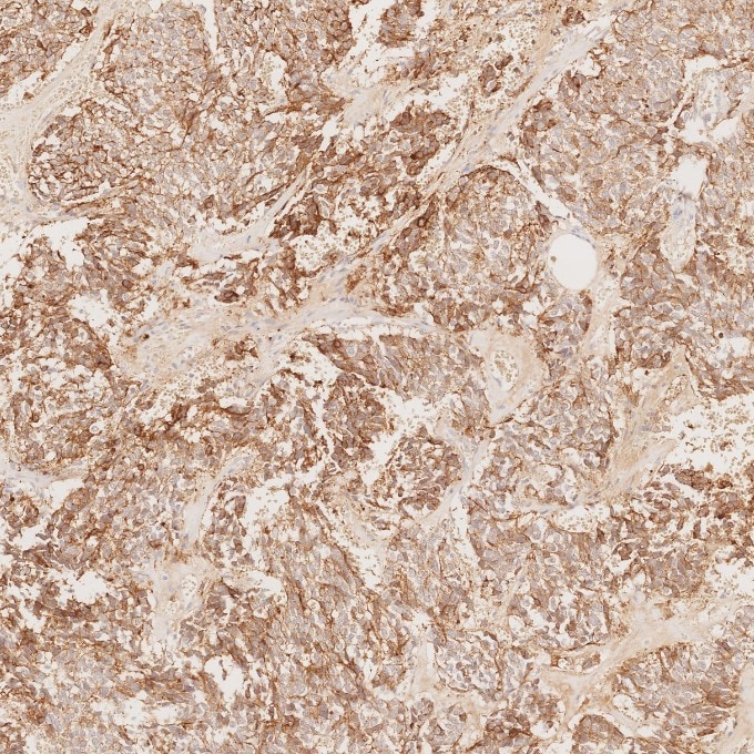 Immunohistochemistry (IHC) staining of human pituitary adenoma tissue using Chromogranin A Monoclonal antibody (60135-2-Ig)