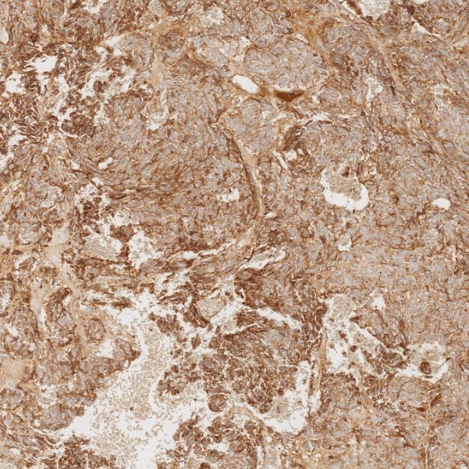 Immunohistochemistry (IHC) staining of human pituitary adenoma tissue using Chromogranin A Monoclonal antibody (60135-2-Ig)